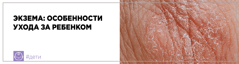 Экзема: особенности ухода за ребенком